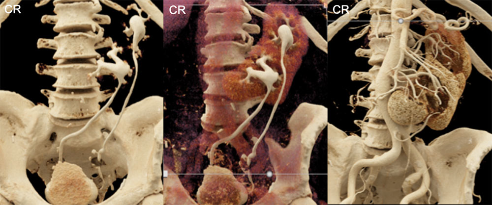 Cross-Fused Renal Ectopia