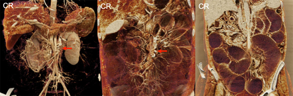 Volvulus with Small Bowel Obstruction