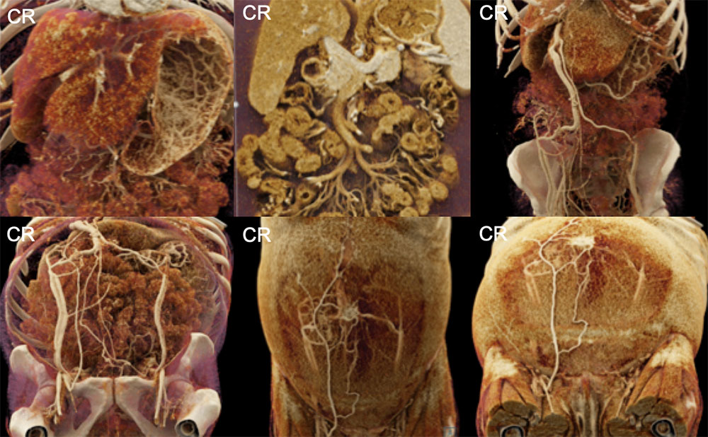 Cirrhosis with Recanalized Umbilical Vein and Ascites