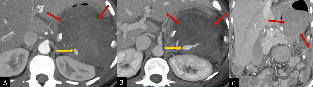 Acute, Perioperative Hemorrhage from Splenic Artery Stump