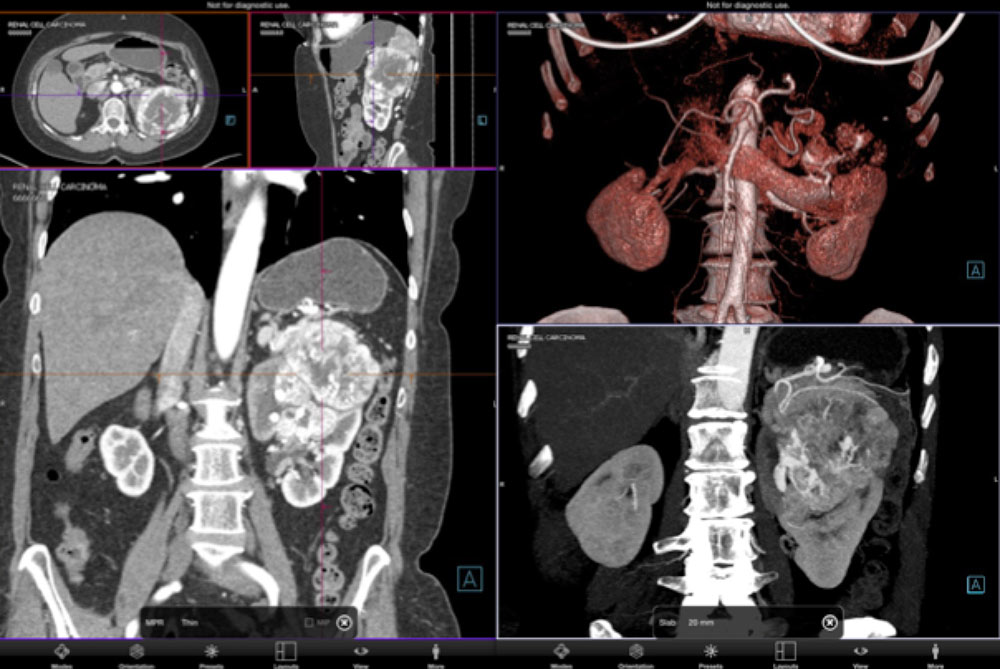 3D Imaging in Radiology: What A Long Strange Trip It's Been