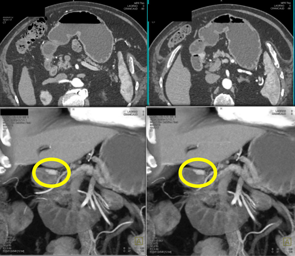 A three-dimensional 3-D chest computed tomography scan on the 17th