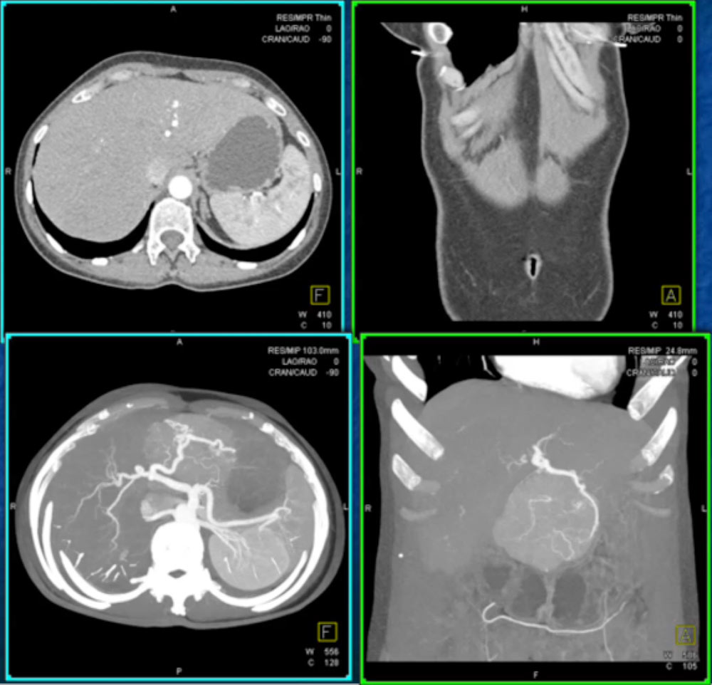 A three-dimensional 3-D chest computed tomography scan on the 17th