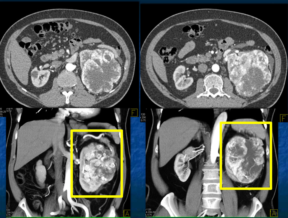 Clear Cell RCC