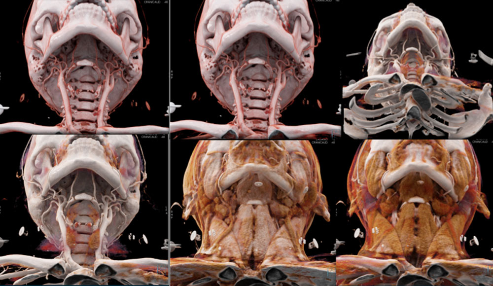 Visualization of the neck with detailed vascular, soft tissue and muscle anatomy is often critical across a range of applications from trauma to infection to oncology