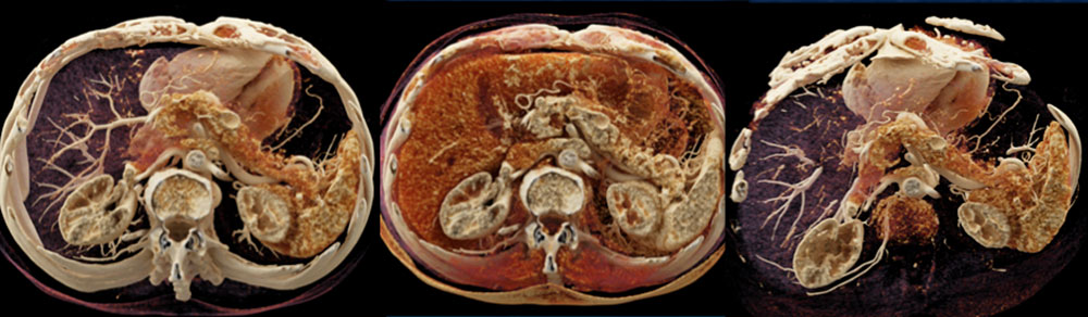 1 cm PNET of the Pancreas
