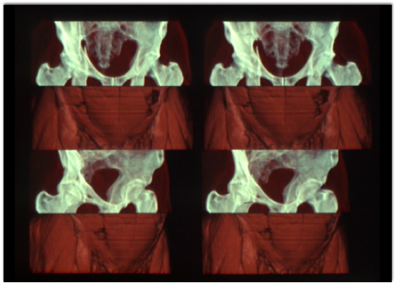 3D Imaging in Radiology: What A Long Strange Trip It's Been