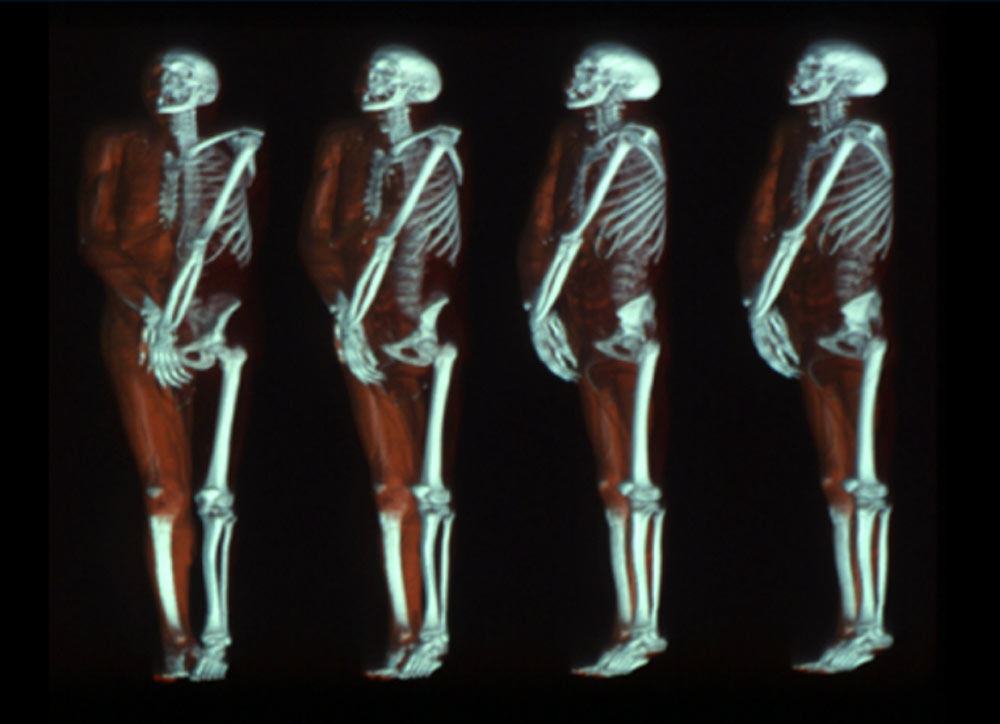 3D Imaging in Radiology: What A Long Strange Trip It's Been