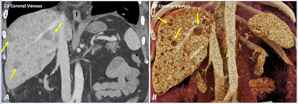 Case 15: Metastatic Head and Neck Squamous Cell Carcinoma