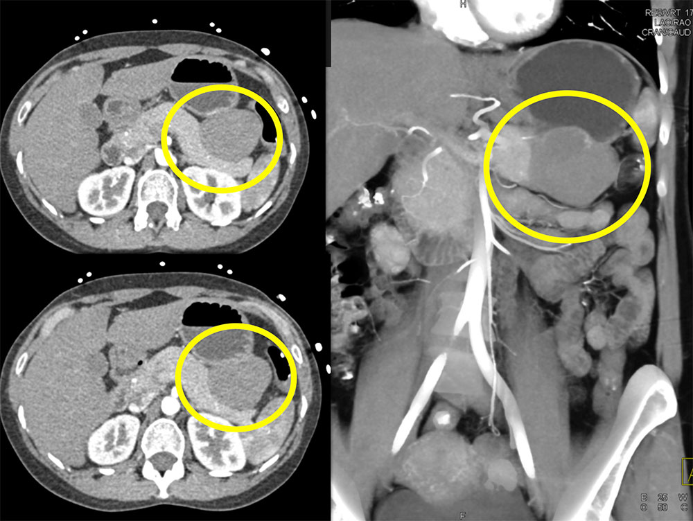 Gastric GIST Tumor Simulates a Mass Arising off the Tail of the Pancreas