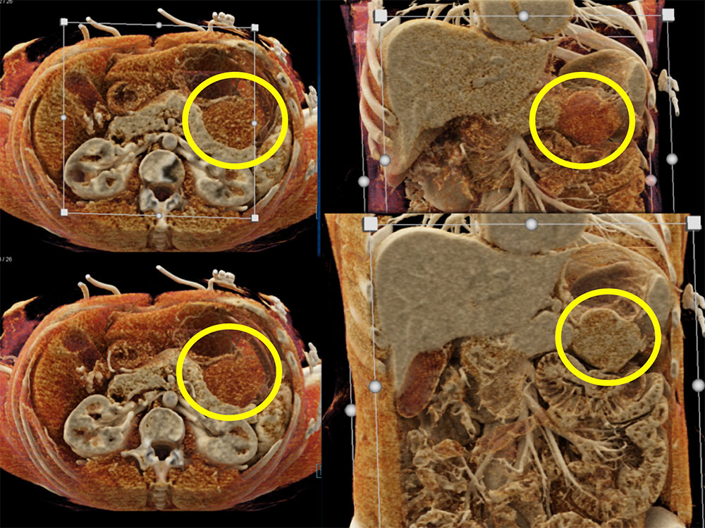 Gastric GIST Tumor Simulates a Mass Arising off the Tail of the Pancreas