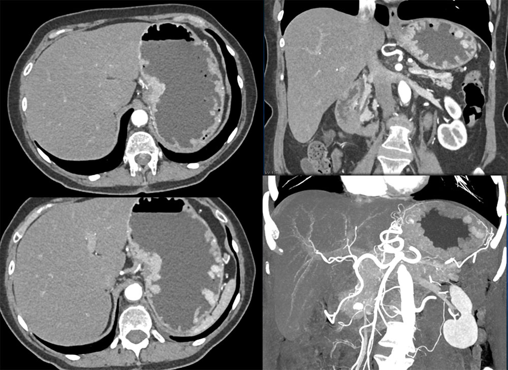 Multiple Gastric Carcinoid Tumors in Patient with MEN 1 Syndrome