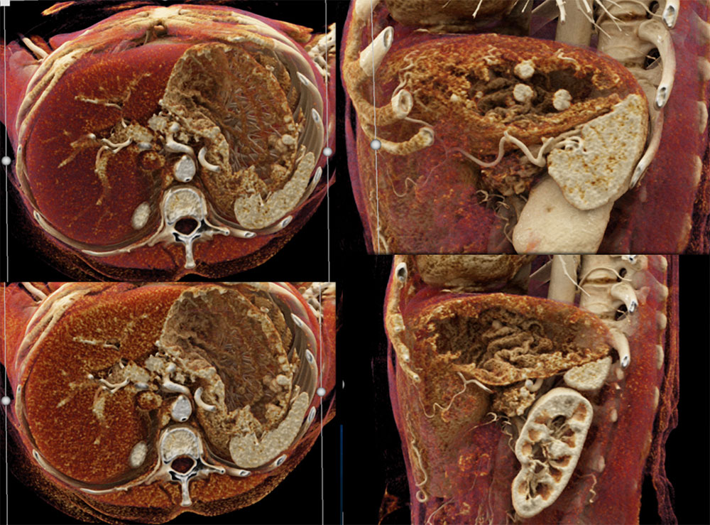 The CR nicely defines the enhancing Multiple Gastric Carcinoid Tumors