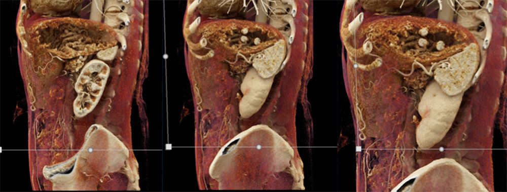 The CR nicely defines the enhancing Multiple Gastric Carcinoid Tumors