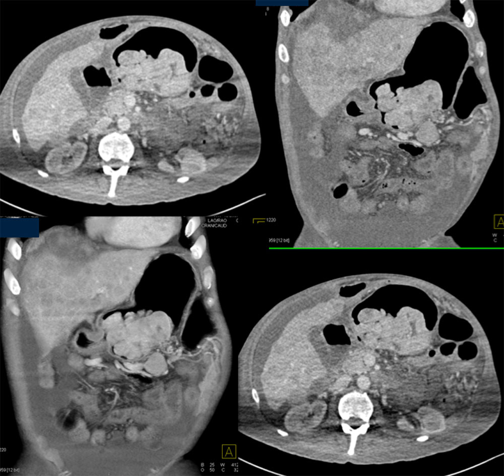 Renal Cell Carcinoma  Metastatic to the Stomach Presenting with GI Bleed