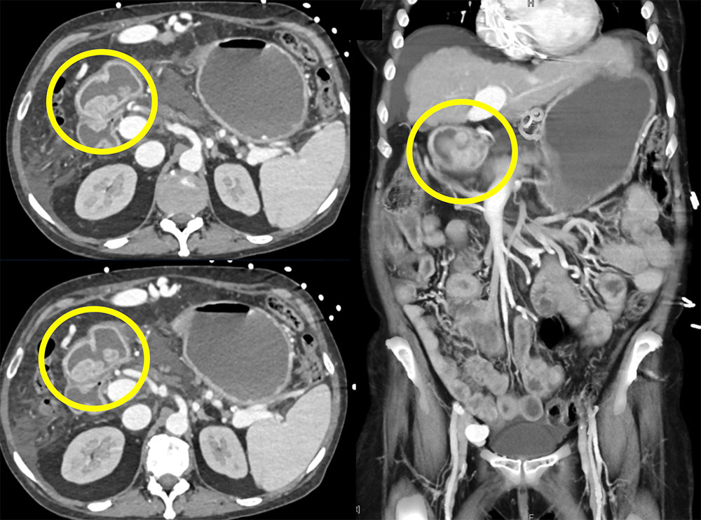 Thickened Mass-like Antral Folds in a Patient with Cirrhosis and Portal Hypertension Simulates a Gastric Tumor