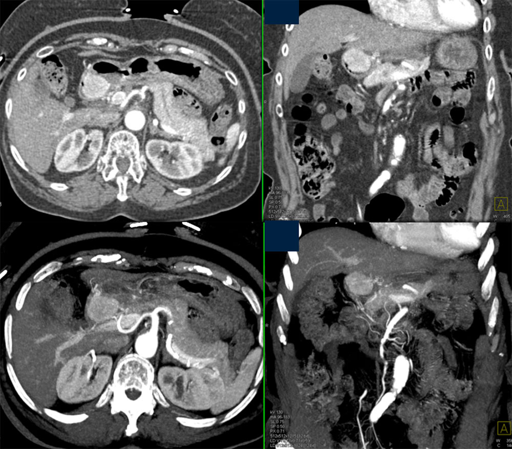 Carcinoid Tumor Gastric Antrum is Hypervascular and Shown Well on Axial, VRT and MIP Images 
