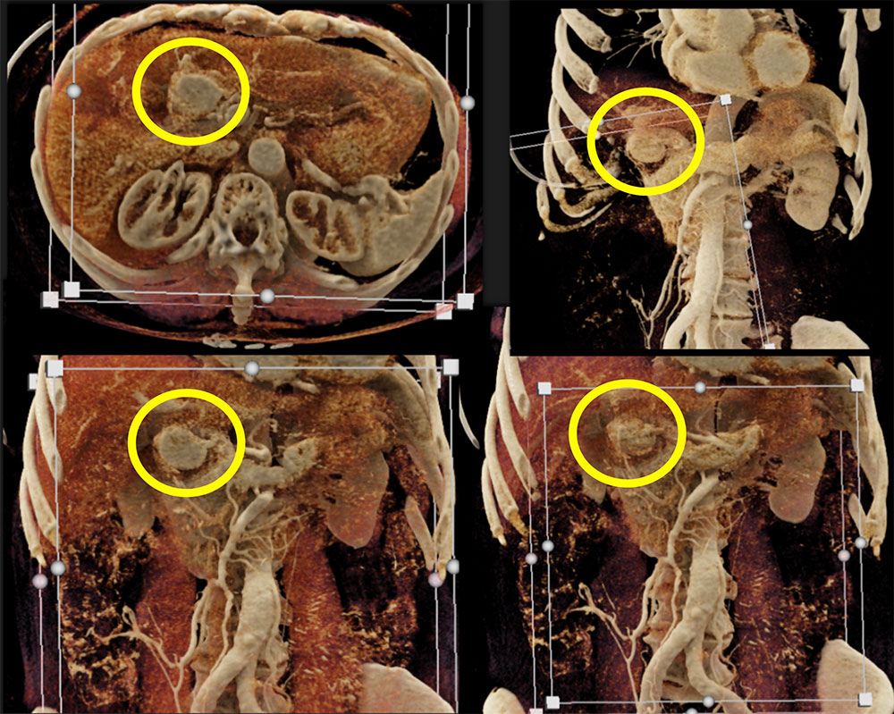 Cinematic Rendering of a Hypervascular Carcinoid Tumor in the Gastric Antrum