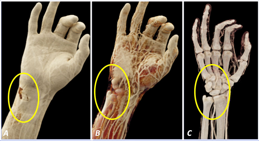 27-year-old man with traumatic right wrist laceration