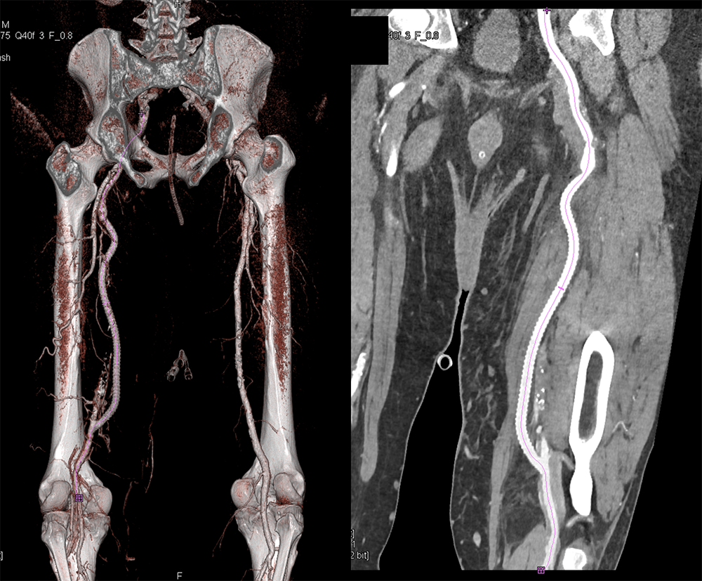 CT of Abdominal Aorta: Aneurysms, Dissections and Repair 