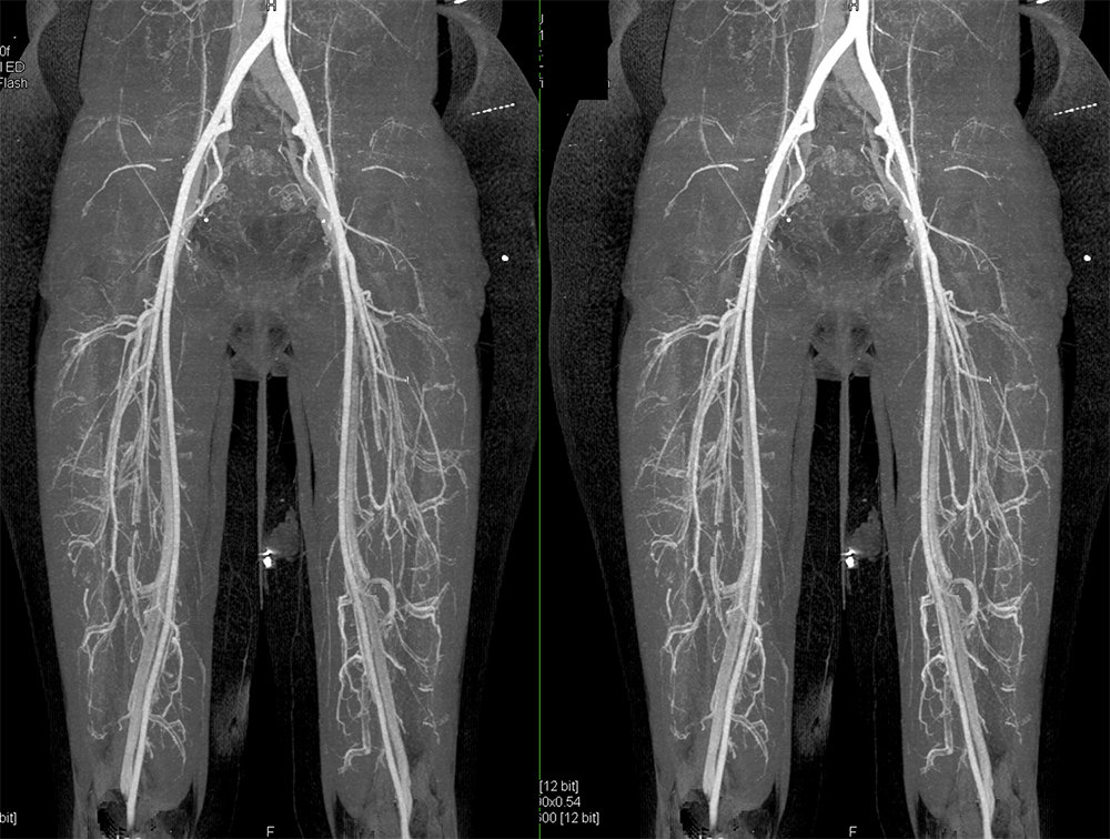 CT of Abdominal Aorta: Aneurysms, Dissections and Repair 