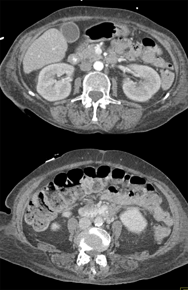 Active Duodenal Bleed