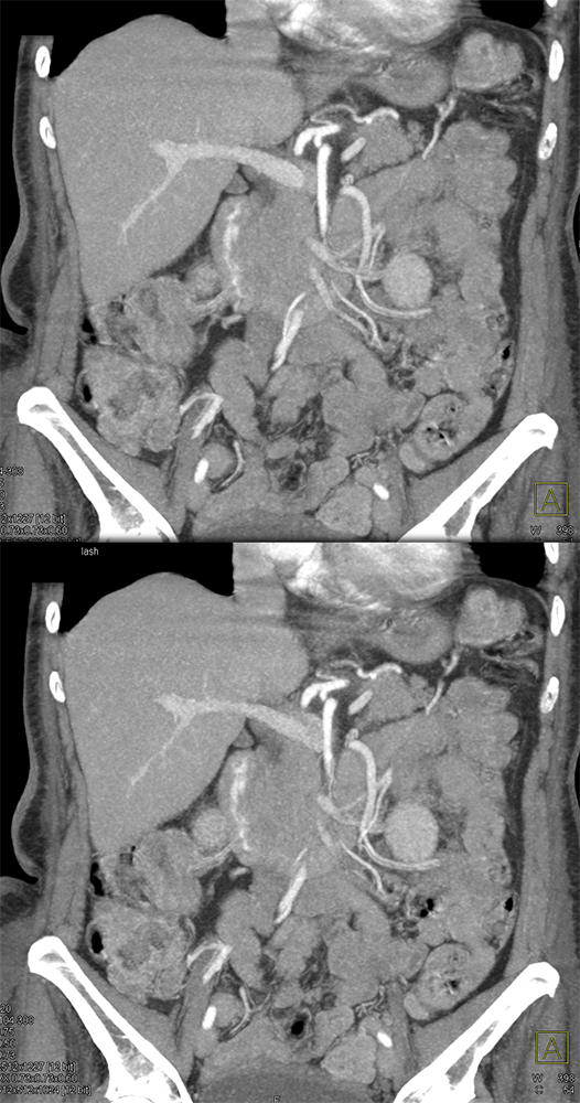 Active Duodenal Bleed