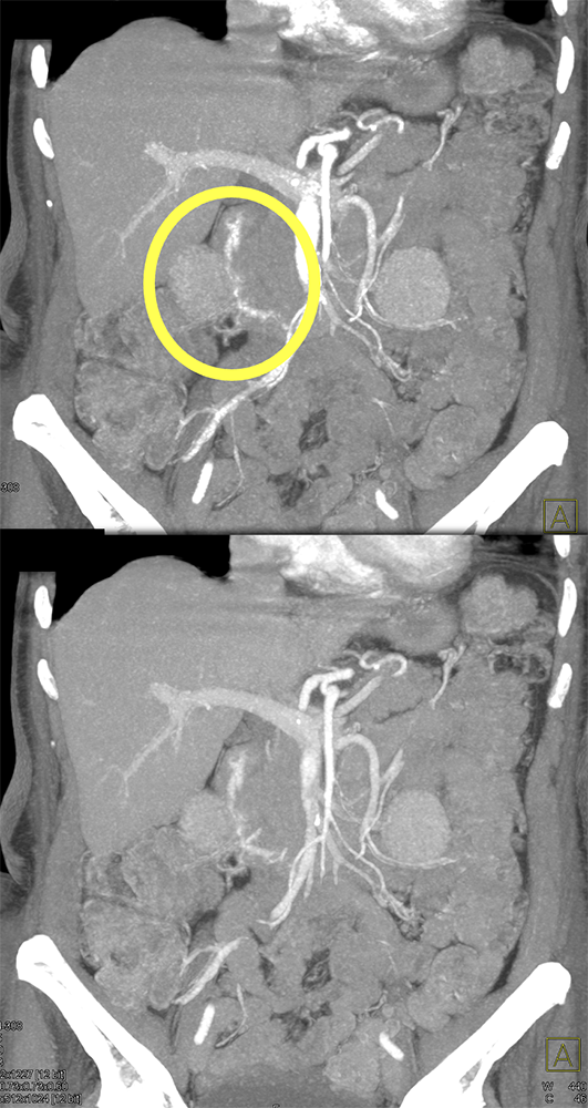 Active Duodenal Bleed