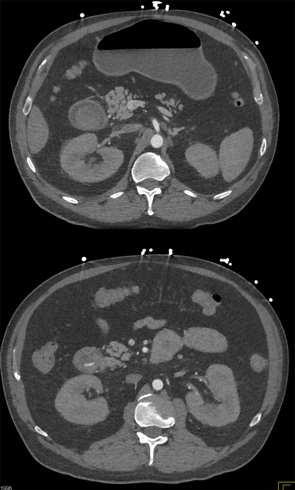 CT of the Acute Abdomen