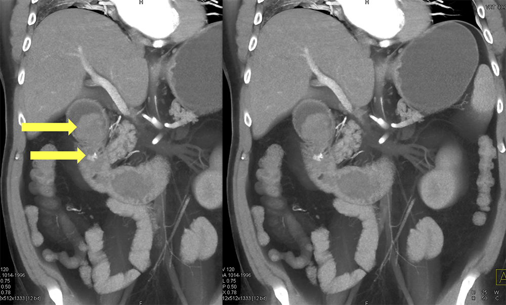 Bleed in Duodenum due to Ulcer 