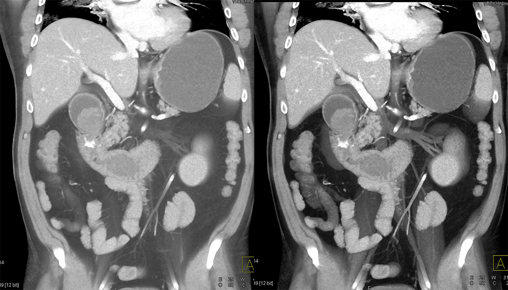 Bleed in Duodenum due to Ulcer 