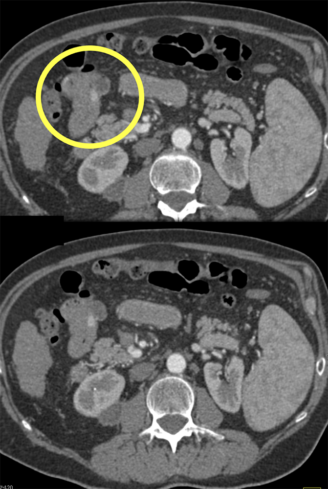 Vascular Foci in Duodenum