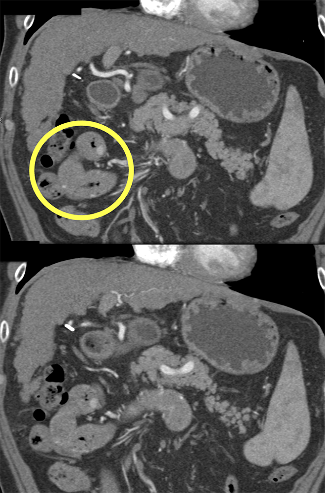 Vascular Foci in Duodenum