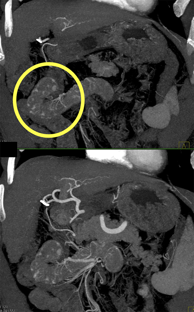 Vascular Foci in Duodenum