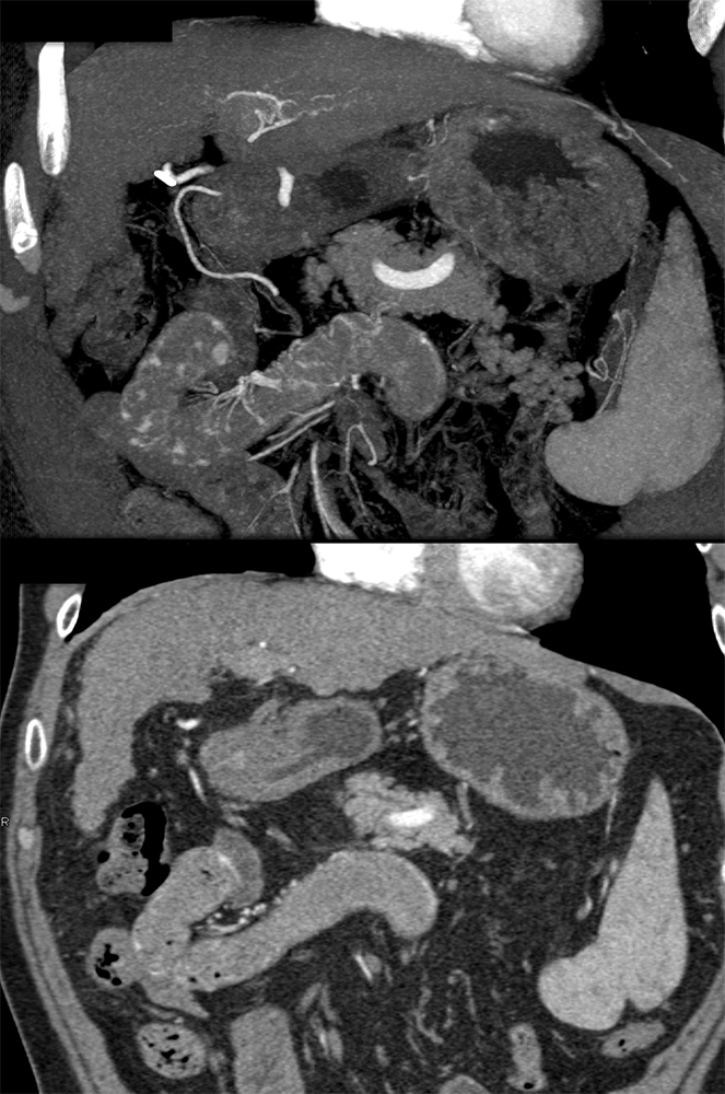 Vascular Foci in Duodenum