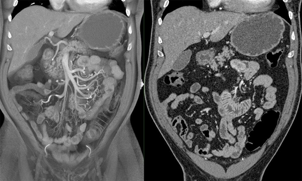 2 cm GIST Jejunum