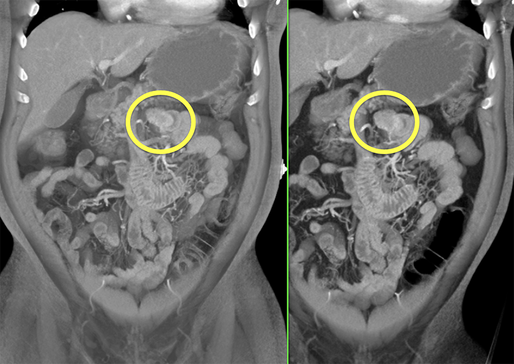 2 cm GIST Jejunum