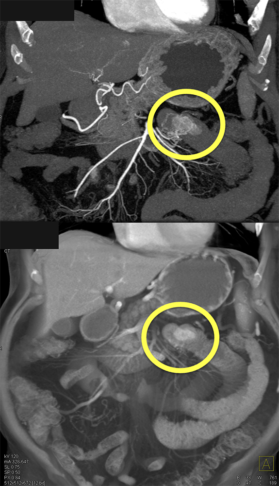 GIST Tumor Jejunum as the Cause of GI Bleeding