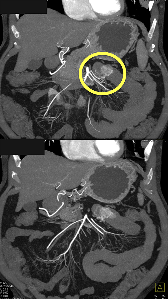 GIST Tumor Jejunum as the Cause of GI Bleeding