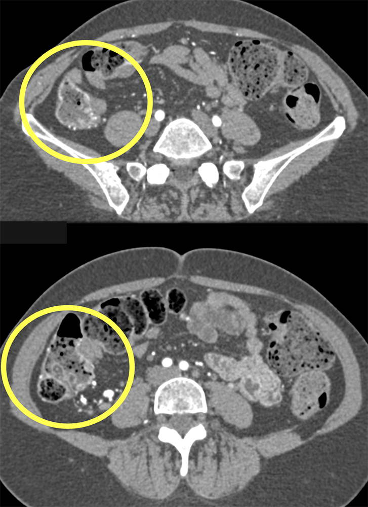 Role of Imaging Vascular Maps Beyond Axial Plane