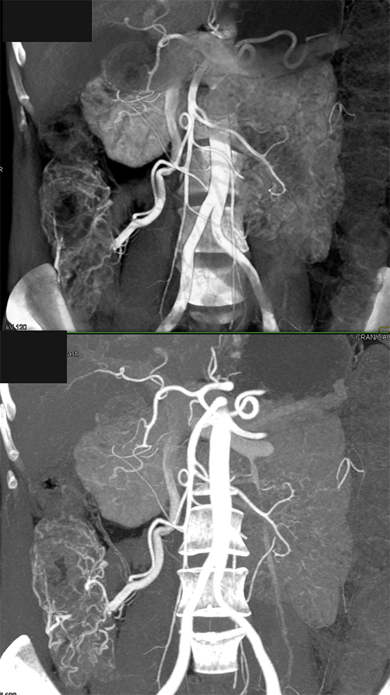 Role of Imaging Vascular Maps Beyond Axial Plane