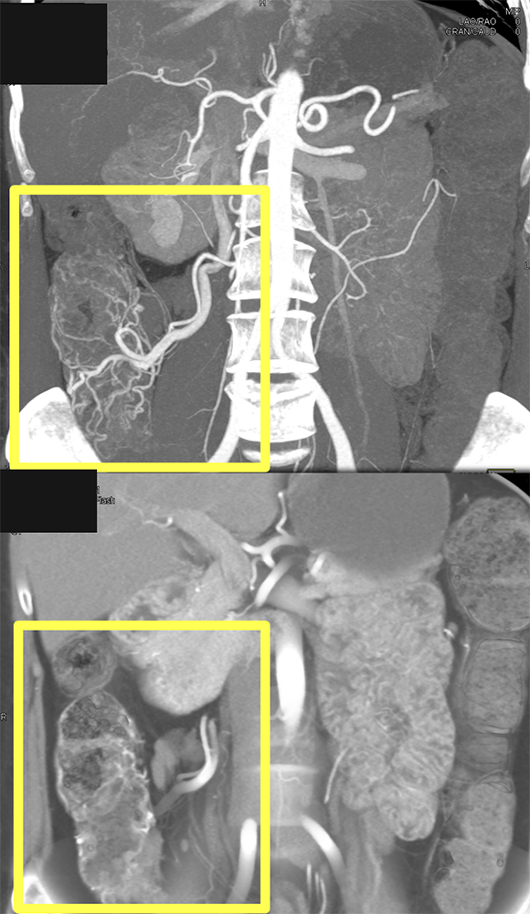 Role of Imaging Vascular Maps Beyond Axial Plane