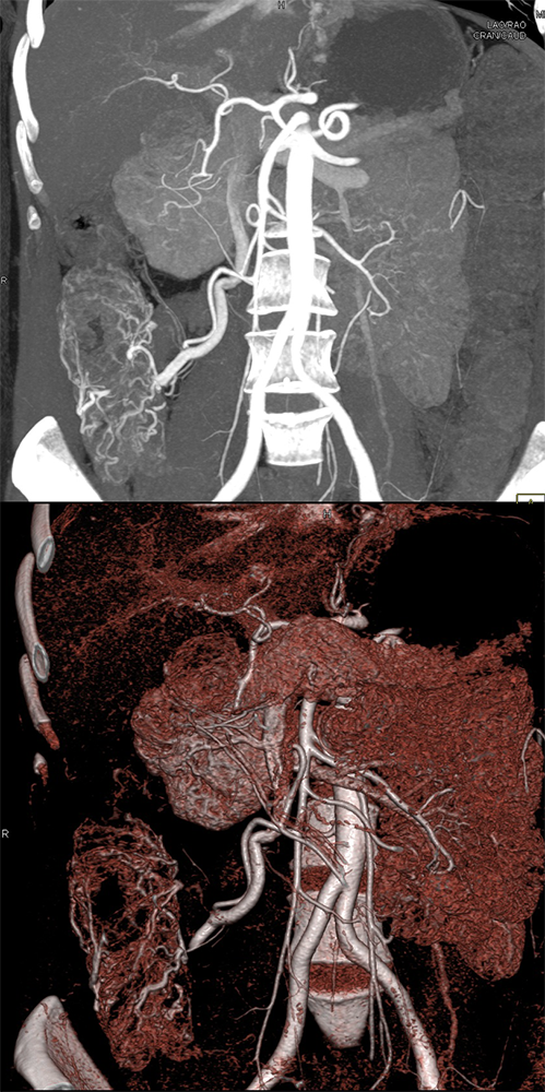 Angiodysplasia