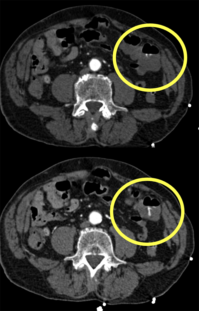 GI Bleed due to Diverticulitis Missed on Arterial Phase