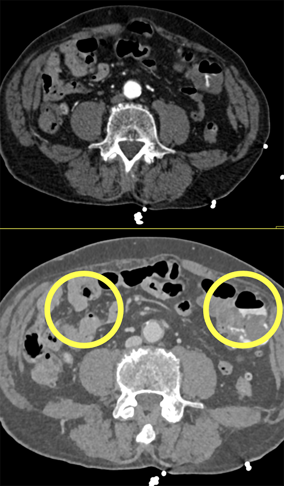 GI Bleed due to Diverticulitis Missed on Arterial Phase