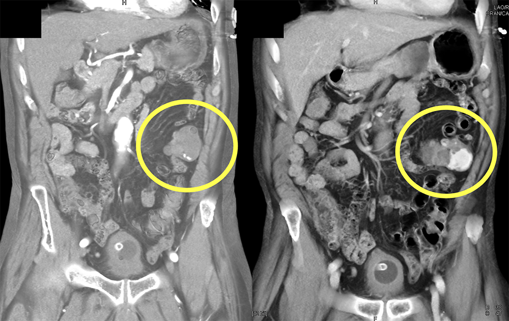 GI Bleed due to Diverticulitis Missed on Arterial Phase