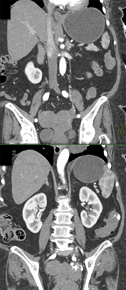 Abdominal Pain and GI Bleeding: ? Etiology