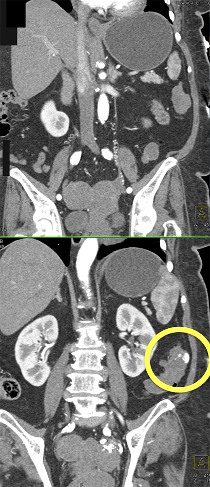 Abdominal Pain and GI Bleeding: ? Etiology