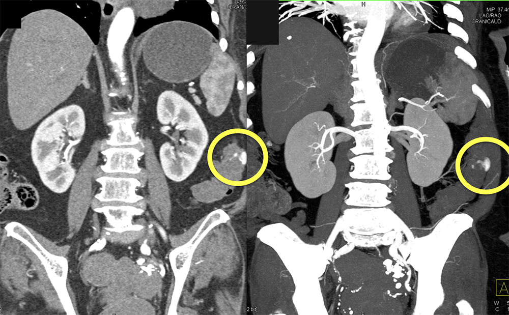 Abdominal Pain and GI Bleeding: ? Etiology