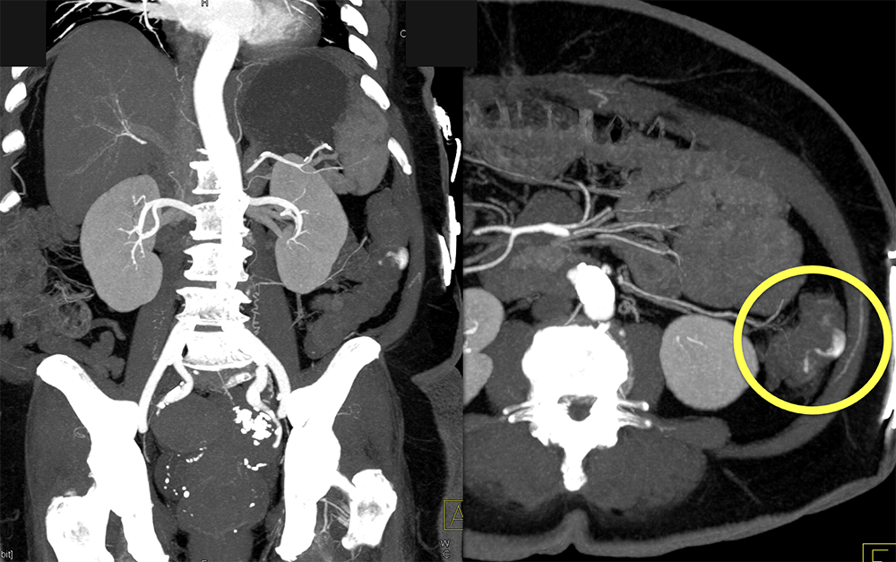 Abdominal Pain and GI Bleeding: ? Etiology